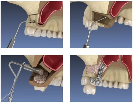 sinus-lift-islemi